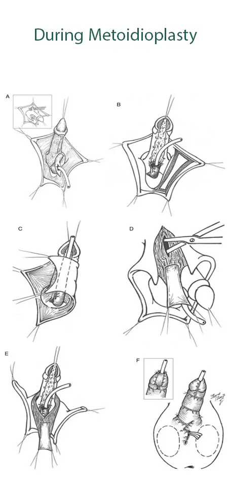 During-metoidioplasty