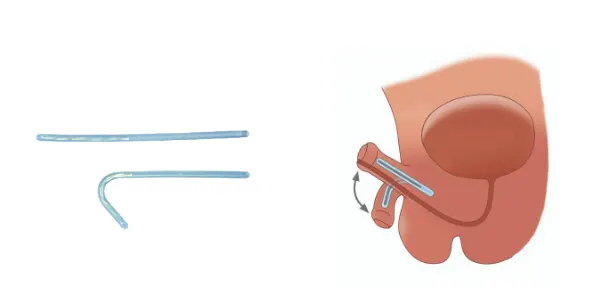 Metoidioplasty