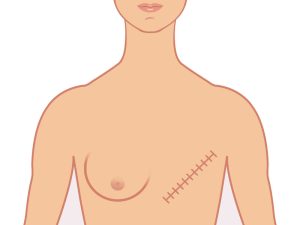 all-about-mastectomy