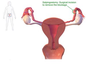 Bilateral Salpingo-Oophorectomy